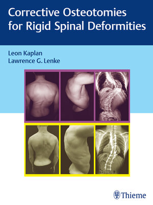 cover image of Corrective Osteotomies for Rigid Spinal Deformities
